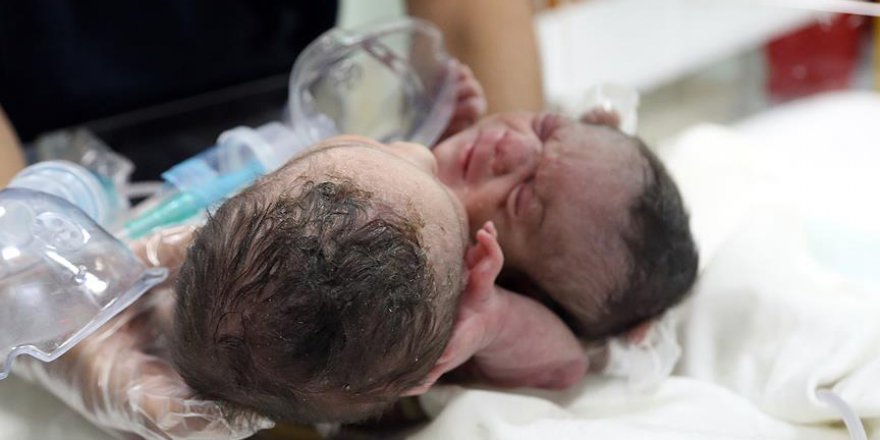 Suriyeli siyam ikizleri Türkiye'ye getirildi