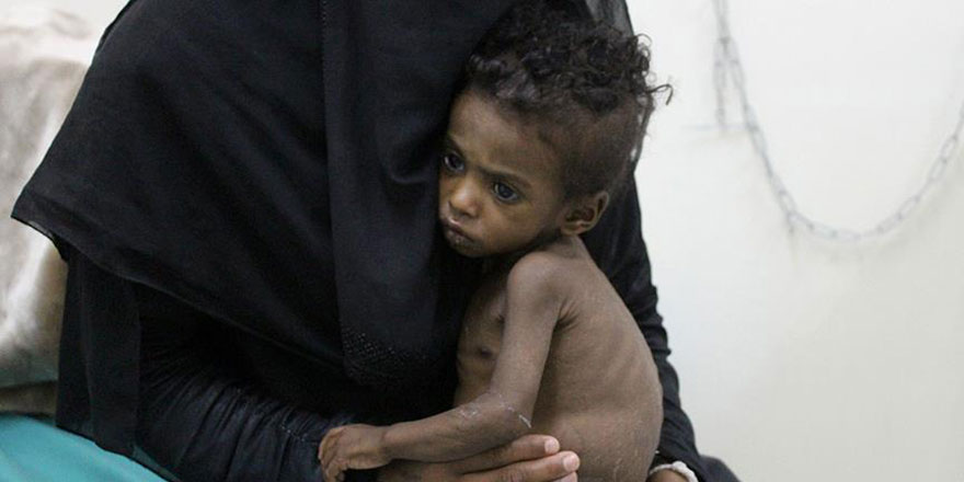 Yemen'de 98 bin çocuk yetersiz beslenmeden ölümle karşı karşıya