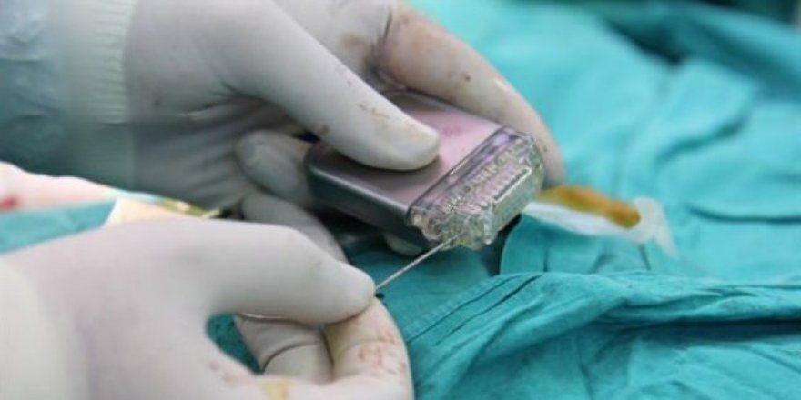 beyin pili uygulamasi hastalari yasama bagliyor beyin pili uygulamasi hastalari yasama bagliyor